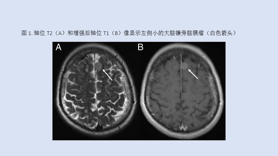 最新脑膜瘤内出现淀粉样血管病改变PPT文档.pptx_第2页