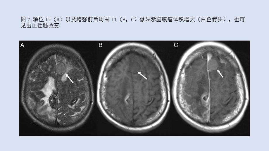 最新脑膜瘤内出现淀粉样血管病改变PPT文档.pptx_第3页