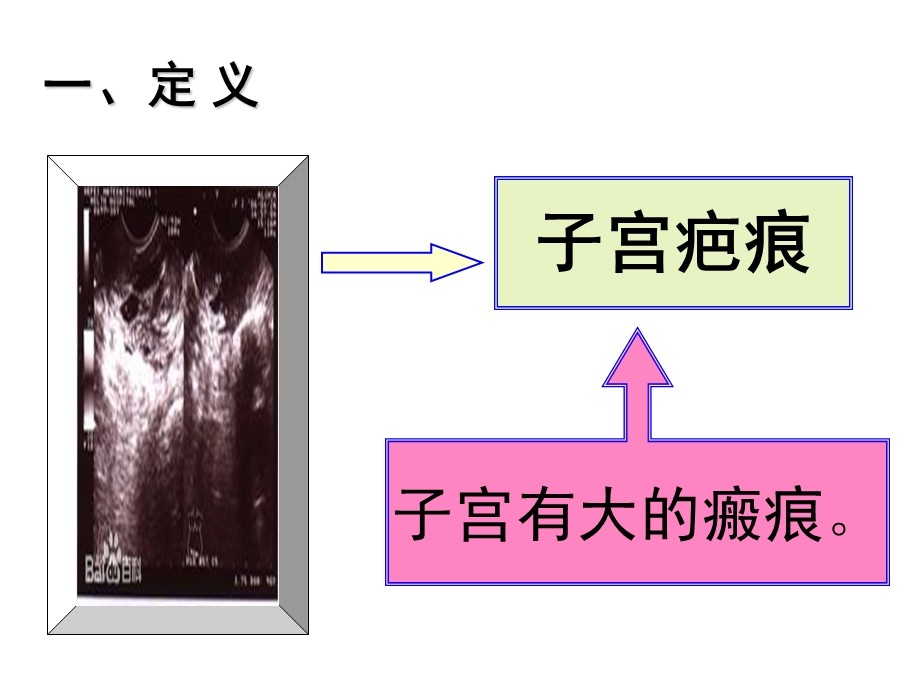 疤痕子宫再次妊娠有关问题的探讨精选文档.ppt_第2页