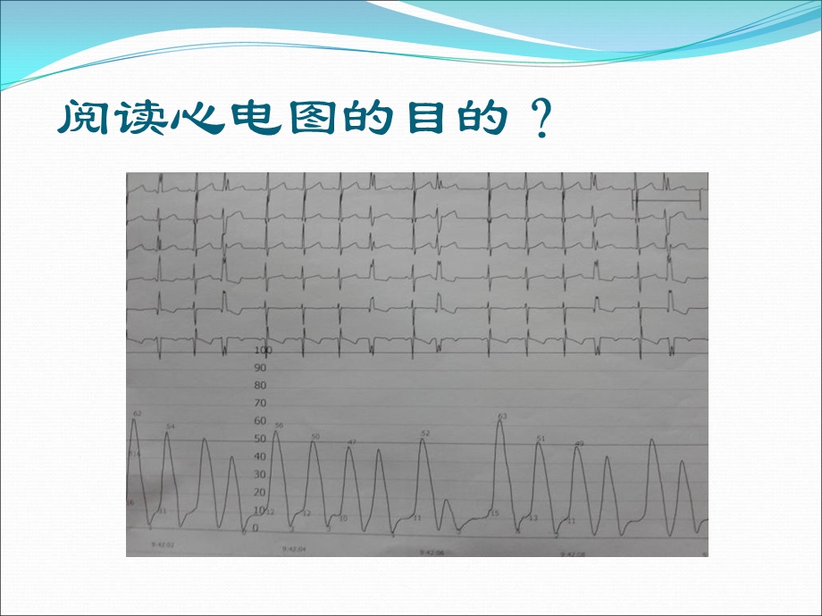 如何阅读儿童心电图文档资料.ppt_第3页