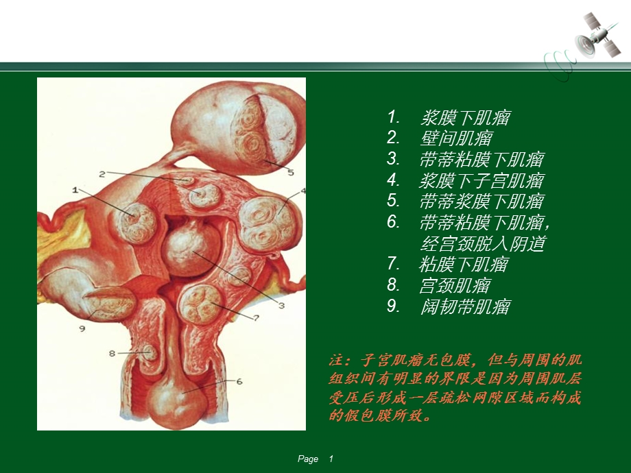 子宫肌瘤1PPT课件.ppt_第1页