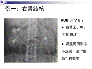 第62章 泌尿系结核典型病例影像的资料课件PPT文档.ppt