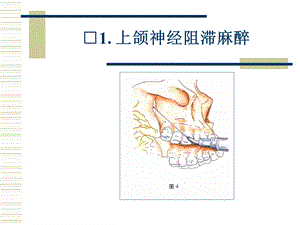 上颌神经阻滞麻醉PPT文档.ppt