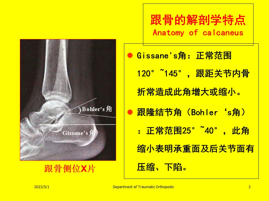 最新：樊仕才 金大地 跟骨骨折的分型和治疗课件文档资料.ppt_第3页