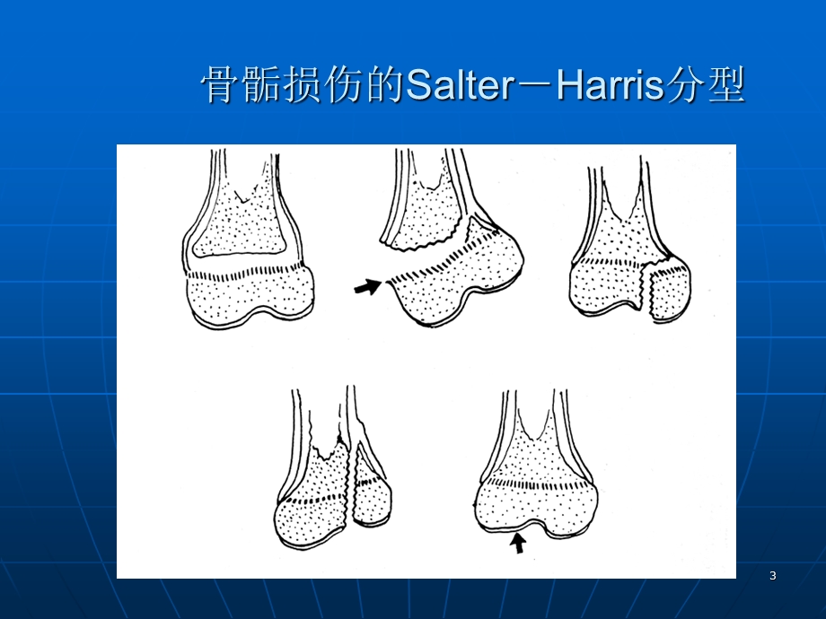 最新：儿童肘关节骨折x线ppt课件文档资料.ppt_第3页