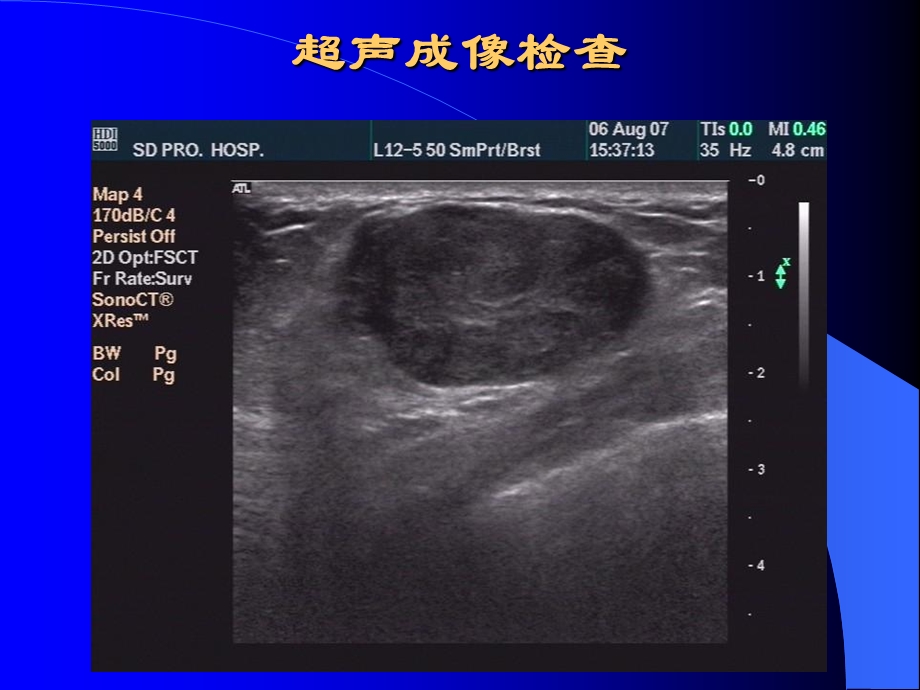 乳腺癌“毛刺征”的病理基础及超声征象精选文档.ppt_第2页