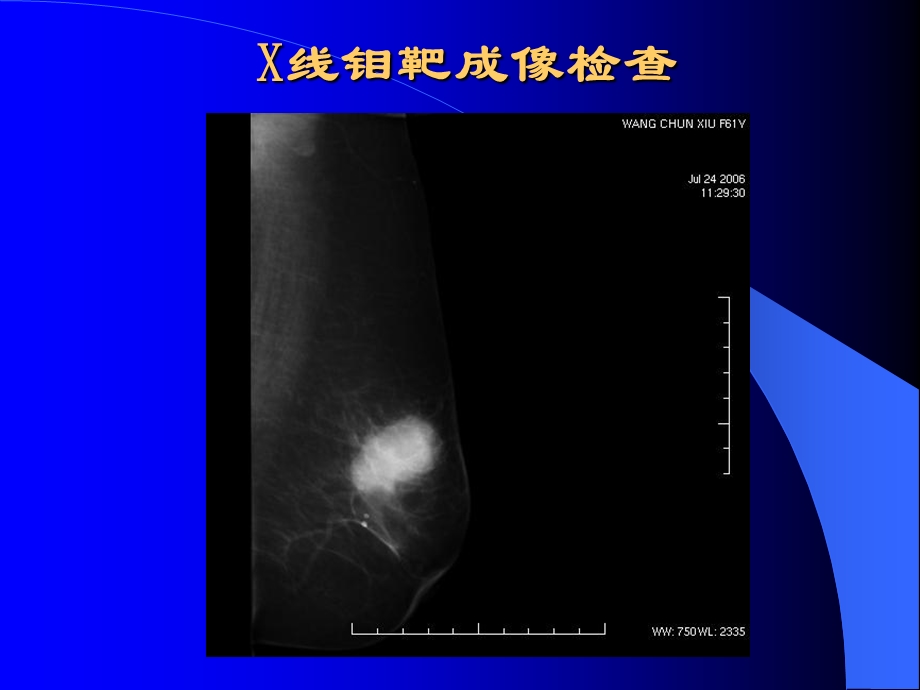 乳腺癌“毛刺征”的病理基础及超声征象精选文档.ppt_第3页