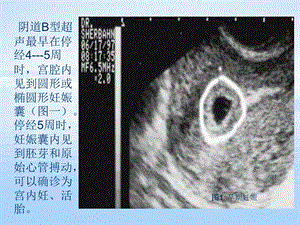 妊娠滋养细胞疾病文档资料.ppt