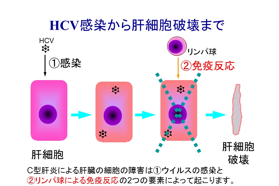 最新：C型肝炎分析课件文档资料.ppt_第2页