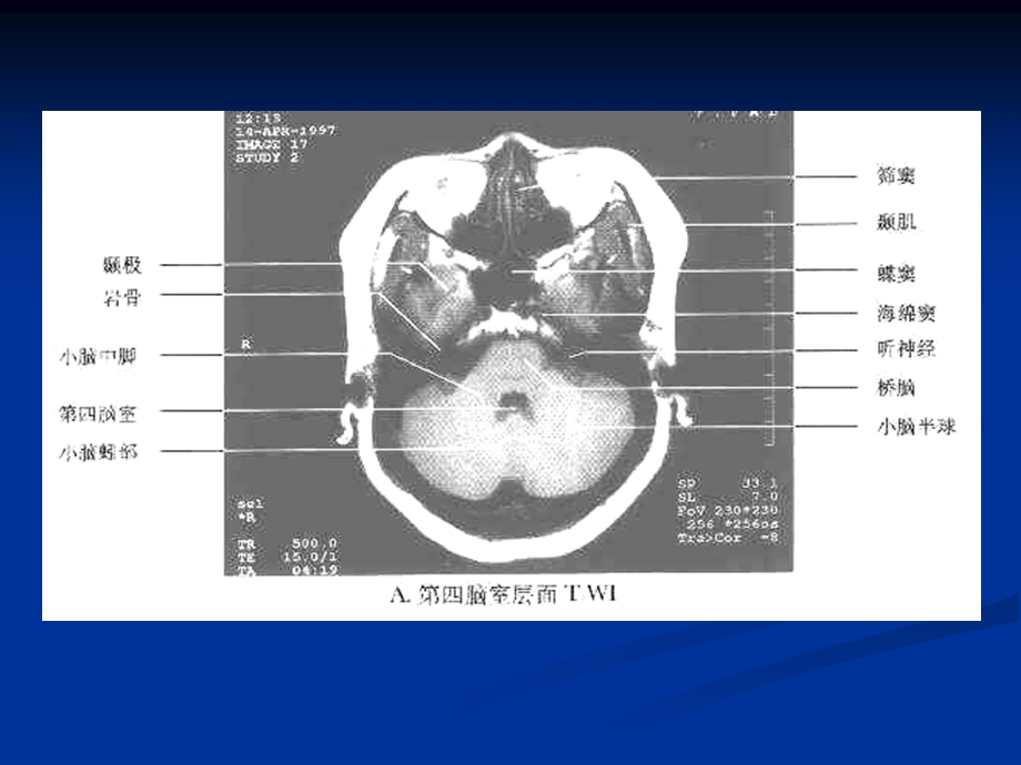 枢神经系统常见肿瘤的mri诊断精选文档.ppt_第1页