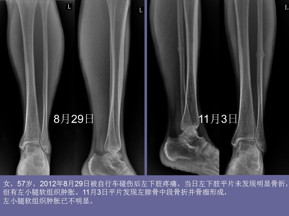 最新不寻常骨折的影像学分析PPT文档.ppt_第1页