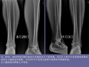 最新不寻常骨折的影像学分析PPT文档.ppt