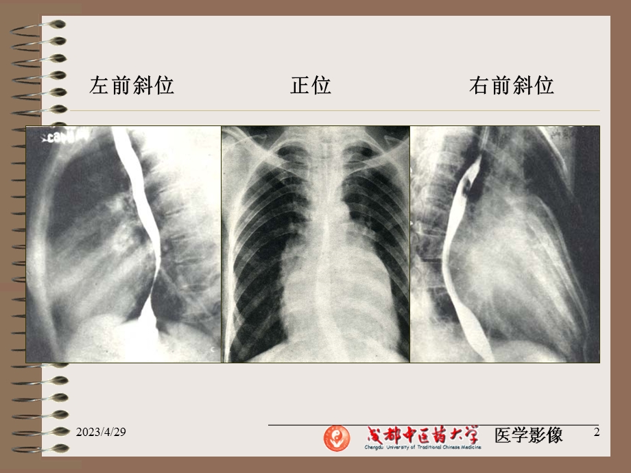 常见病X线诊断PPT文档.ppt_第2页