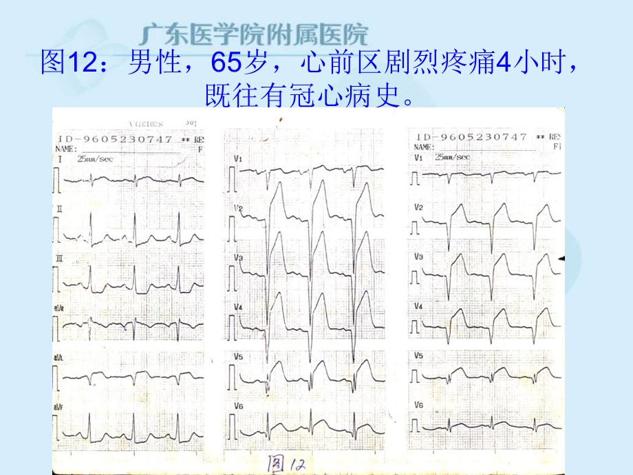 最新：异常心电图见习课文档资料.ppt_第3页