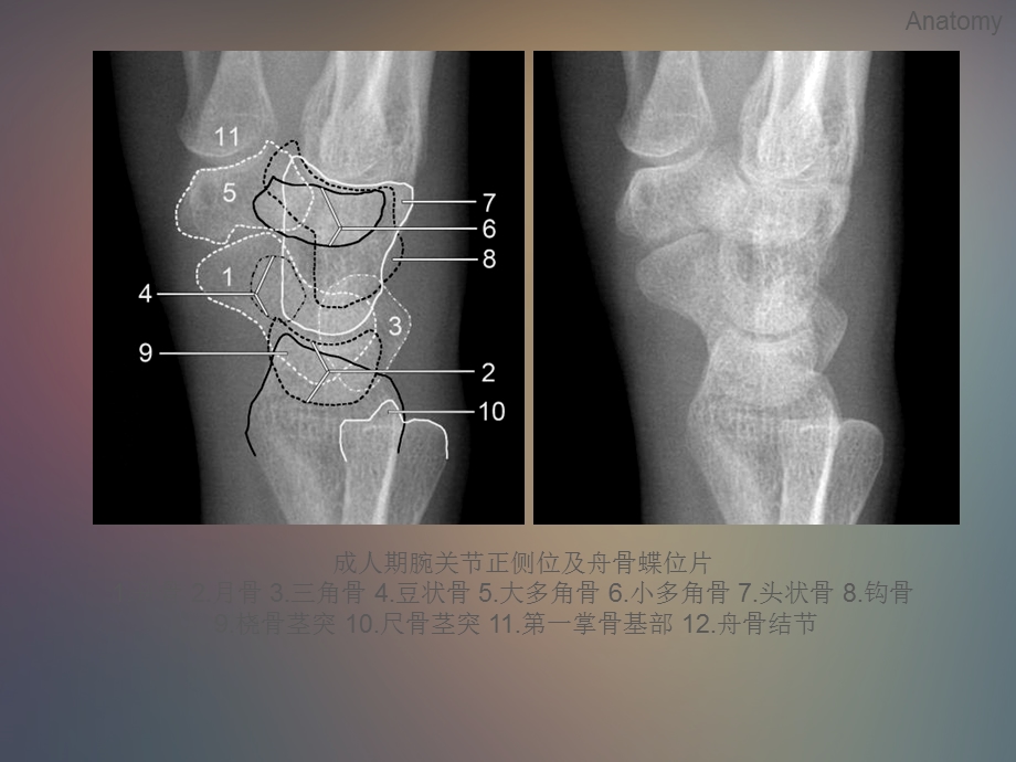 最新：腕关节x线解剖测量分析文档资料.ppt_第3页