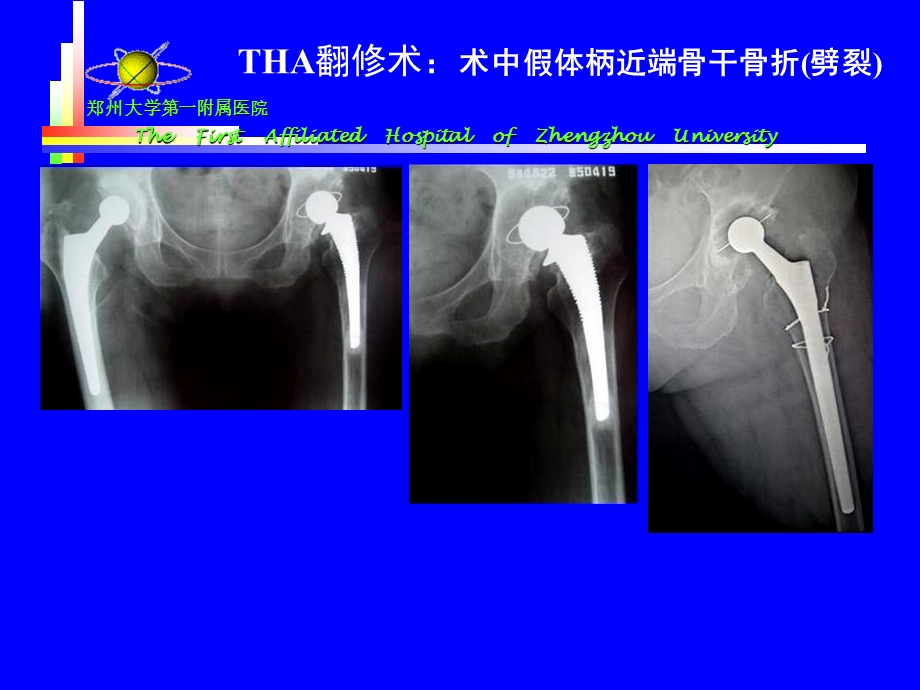 5王义生THA术中股骨骨折处理精选文档.ppt_第3页