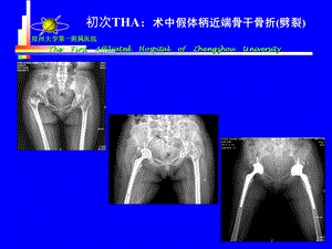 5王义生THA术中股骨骨折处理精选文档.ppt