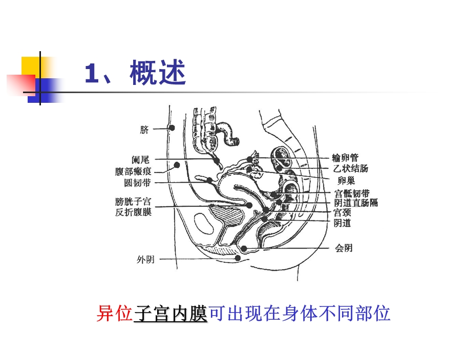 妇产科学23子宫内膜异位症和子宫腺肌病PPT文档.ppt_第3页