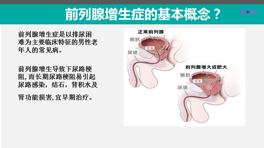 前列腺增生标准课件课件文档资料.ppt_第3页