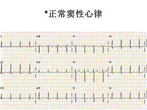 最新心电图PPT文档.ppt