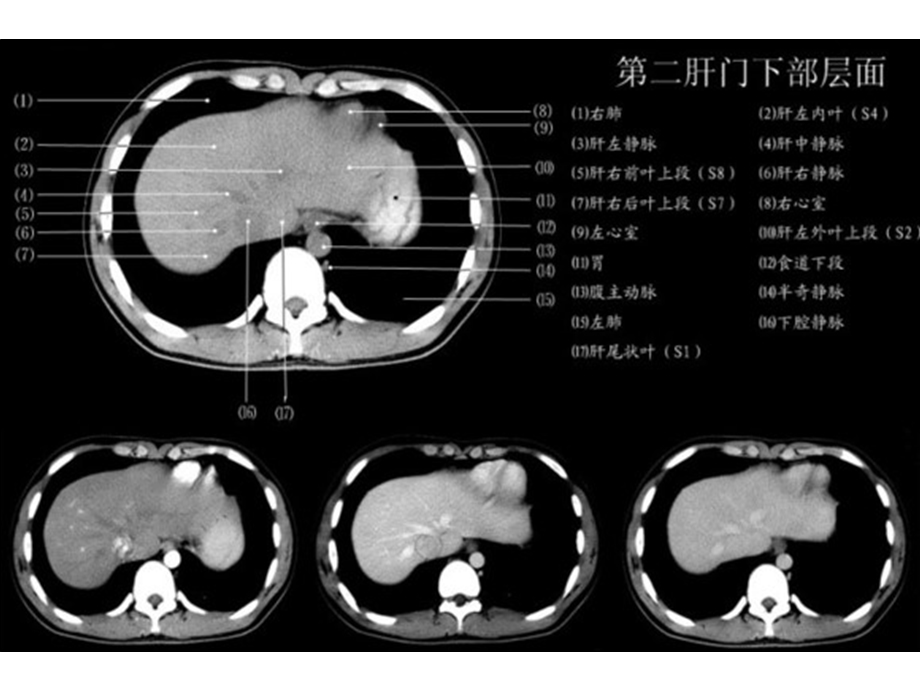 最新上腹部CT各层面课件PPT文档.ppt_第3页