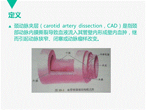 最新颈动脉夹层PPT课件PPT文档.ppt