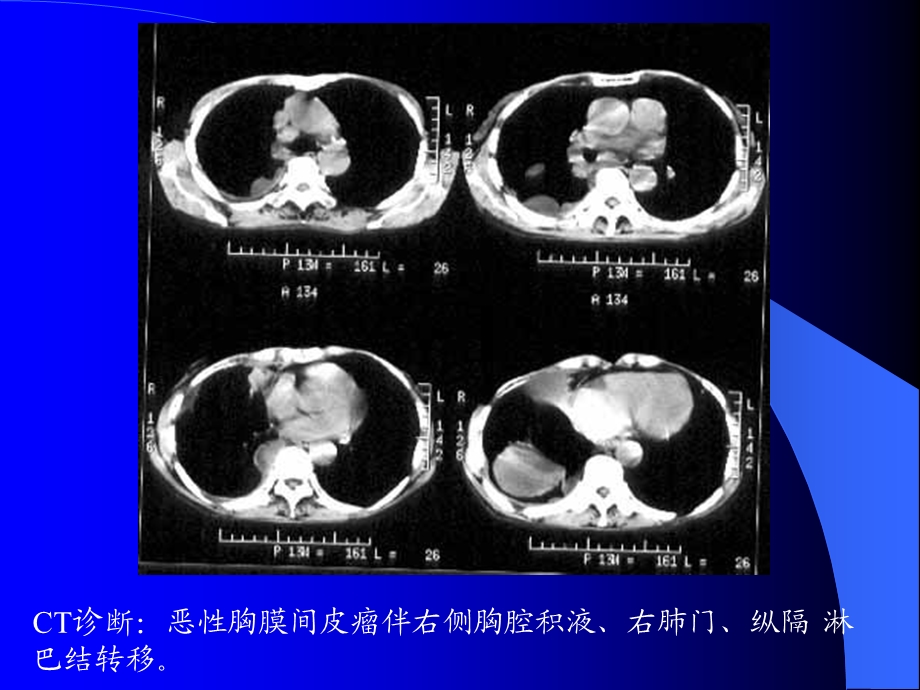 最新常见胸部疾病CTPPT文档.ppt_第2页