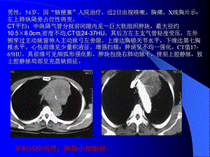 最新常见胸部疾病CTPPT文档.ppt