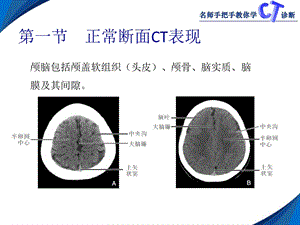 第二章颅脑CT文档资料.ppt