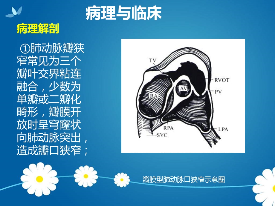 最新肺动脉口狭窄、主动脉狭窄课件PPT文档.ppt_第2页