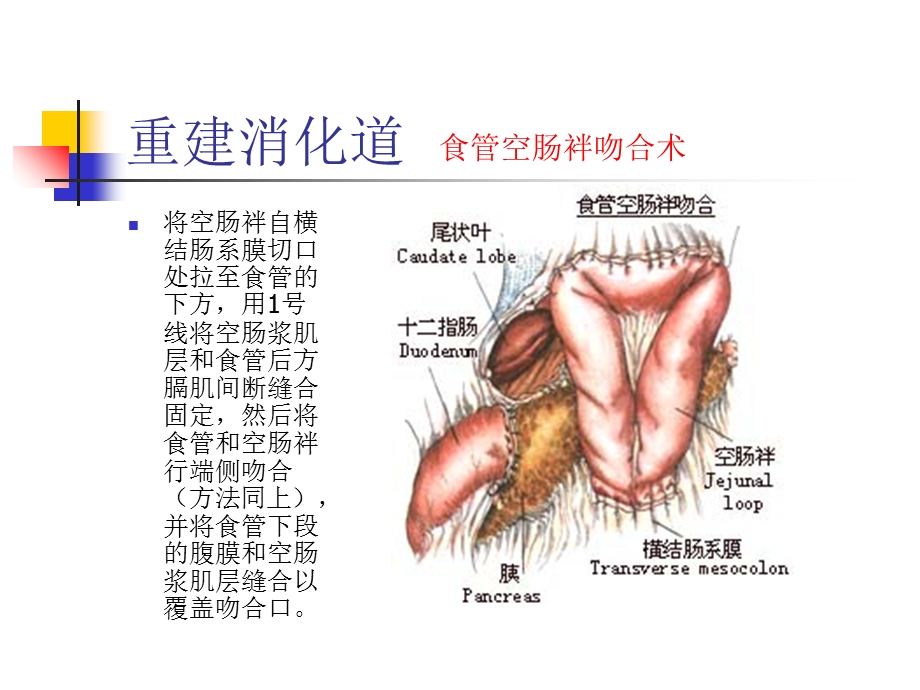 图解全胃切除手术三精选文档.ppt_第3页