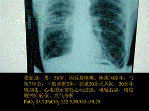 慢性肺源性心脏病精选文档.ppt