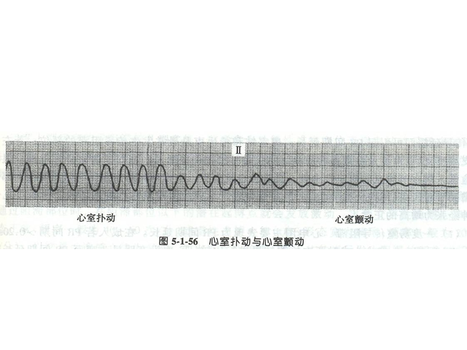 最新：诊断学课件心图3文档资料.ppt_第3页