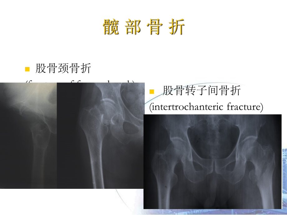 最新：下肢骨折及关损伤文档资料.ppt_第1页