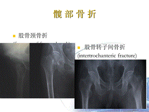 最新：下肢骨折及关损伤文档资料.ppt