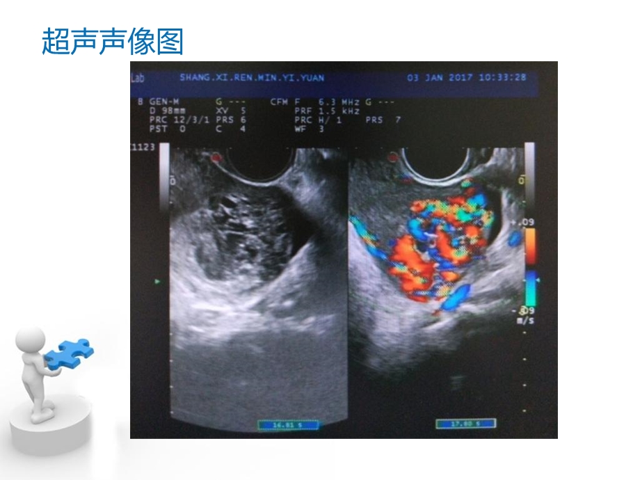 子宫动静脉瘘超声诊断PPT课件.ppt_第3页