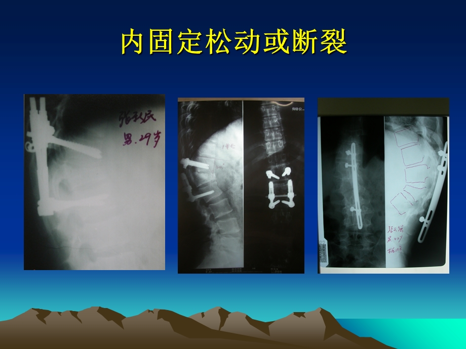 最新经椎弓根椎体截骨矫形治疗胸腰椎陈旧骨折继发脊柱后凸畸形西安红会医院脊柱外科郝定均郑永宏等ppt课件PPT文档.ppt_第3页