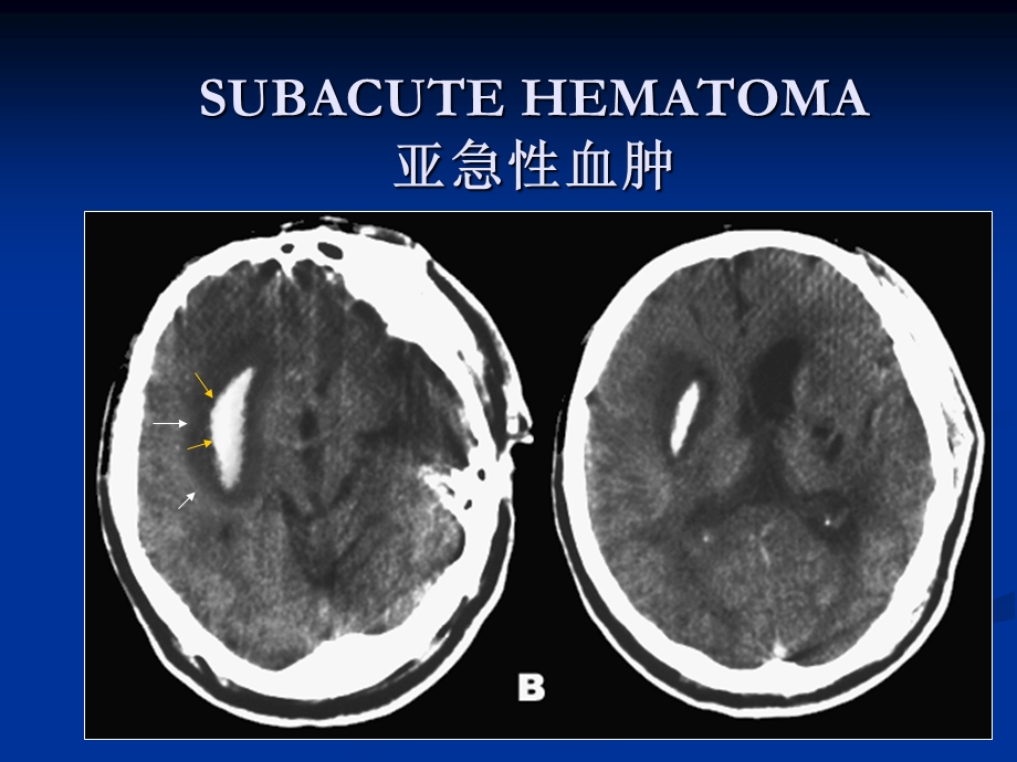 医学影像诊断学06脑血管病及颅内感染文档资料.ppt_第3页