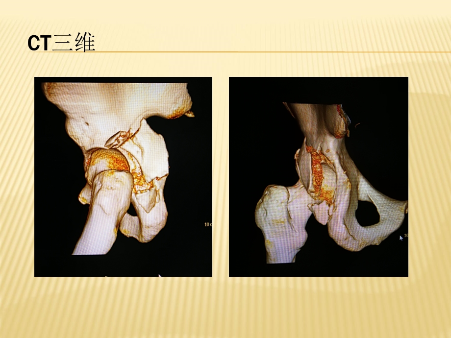 左髋臼后壁骨折病例介绍ppt课件精选文档.ppt_第3页