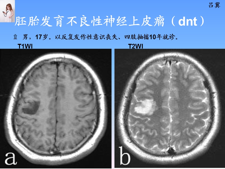 最新医影在线CNS疾病影像图库PPT文档.ppt_第1页