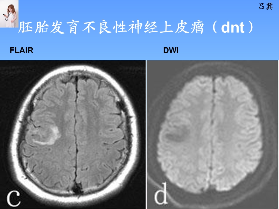 最新医影在线CNS疾病影像图库PPT文档.ppt_第2页