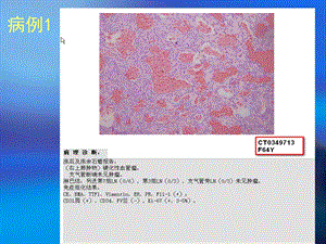 最新：肺部错构瘤ct鉴别诊断病例随访ppt课件文档资料.ppt