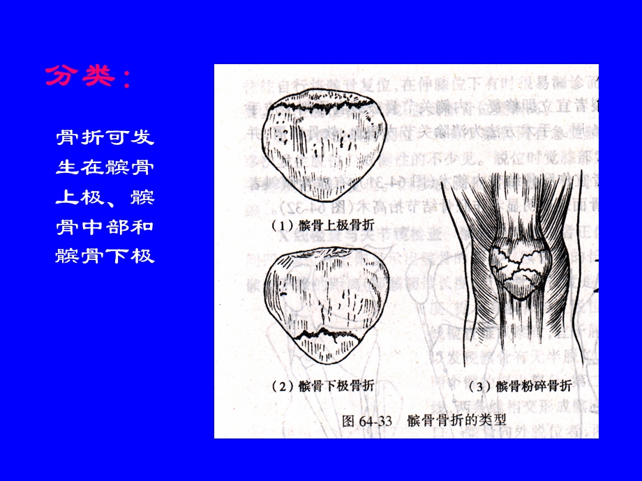 最新：外科学多媒体课件 髌骨骨折文档资料.ppt_第2页