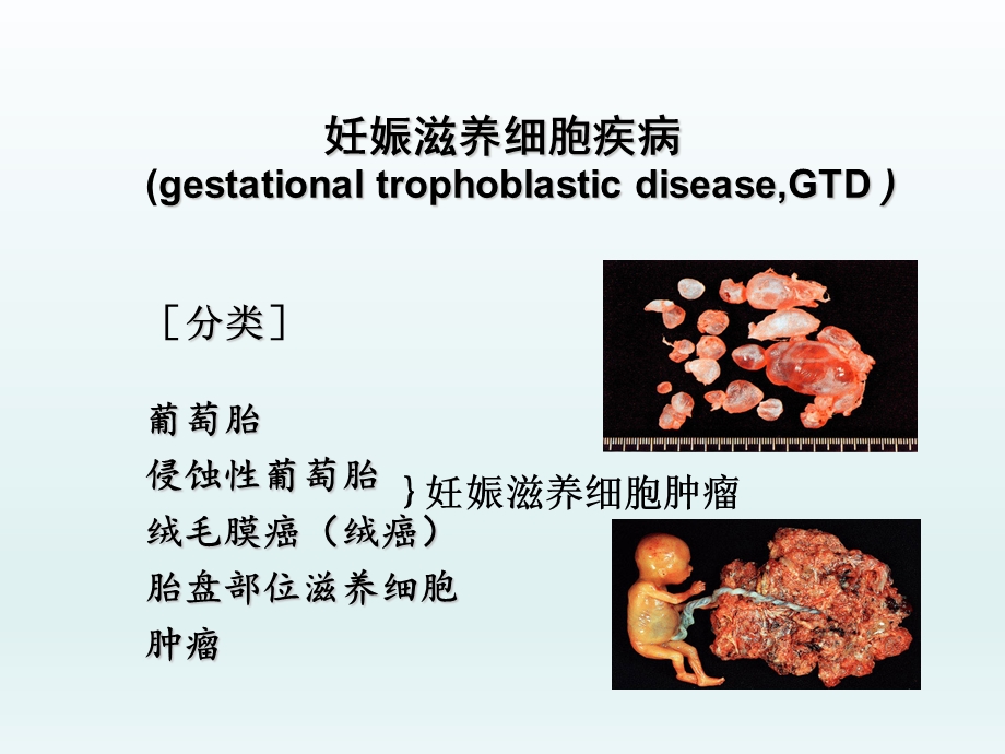 最新妇产科学——妊娠滋养细胞疾病PPT文档.ppt_第2页