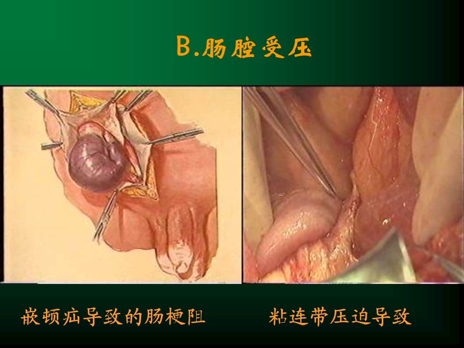 定义任何原因引起的肠内容物不能正常运行,顺利通过肠道,称肠梗阻精选文档.ppt_第3页