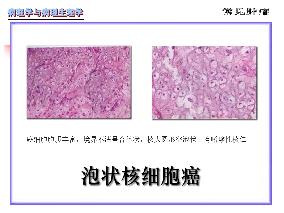 病理学第5章肿瘤精选文档.ppt_第3页