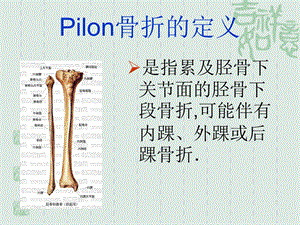 Pilon骨折的诊治现状与进展PPT课件.ppt