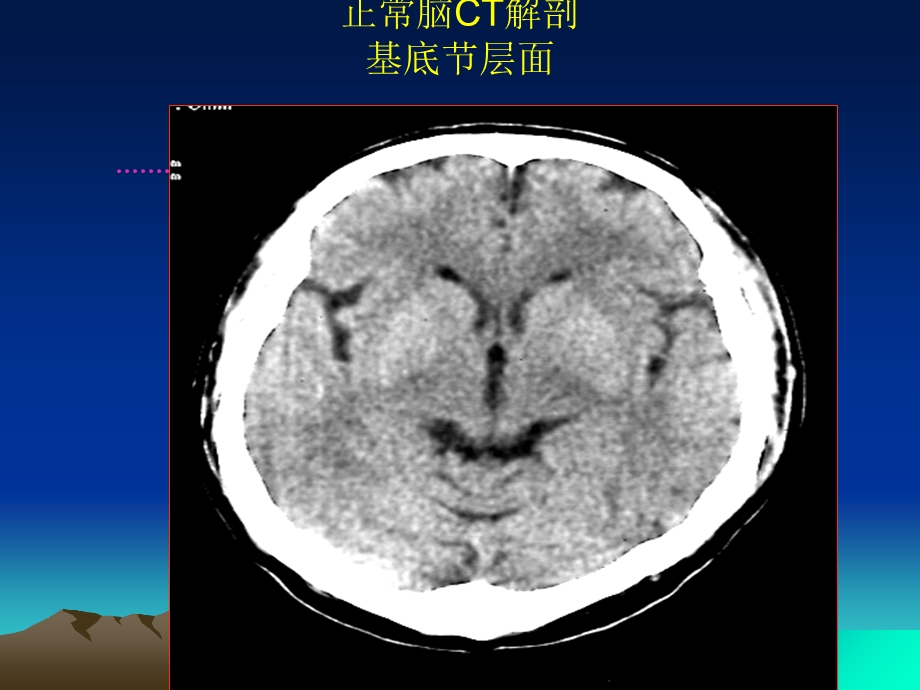 最新：中枢神经系统影像诊断学课件文档资料.ppt_第3页