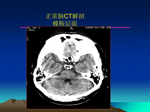 最新：中枢神经系统影像诊断学课件文档资料.ppt