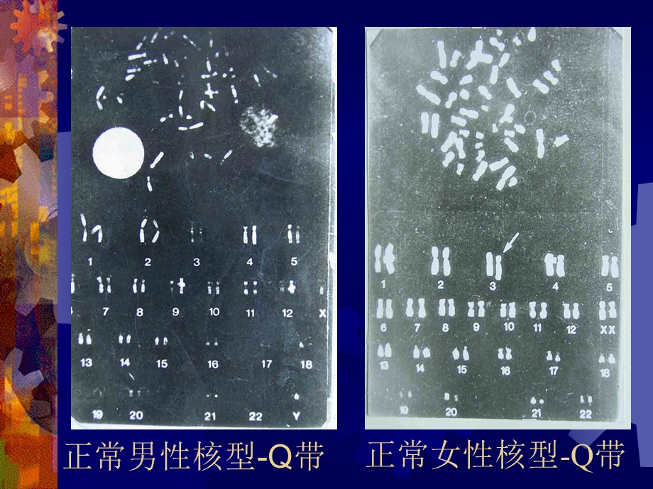 9人类染色体畸变及疾病PPT课件.ppt_第3页